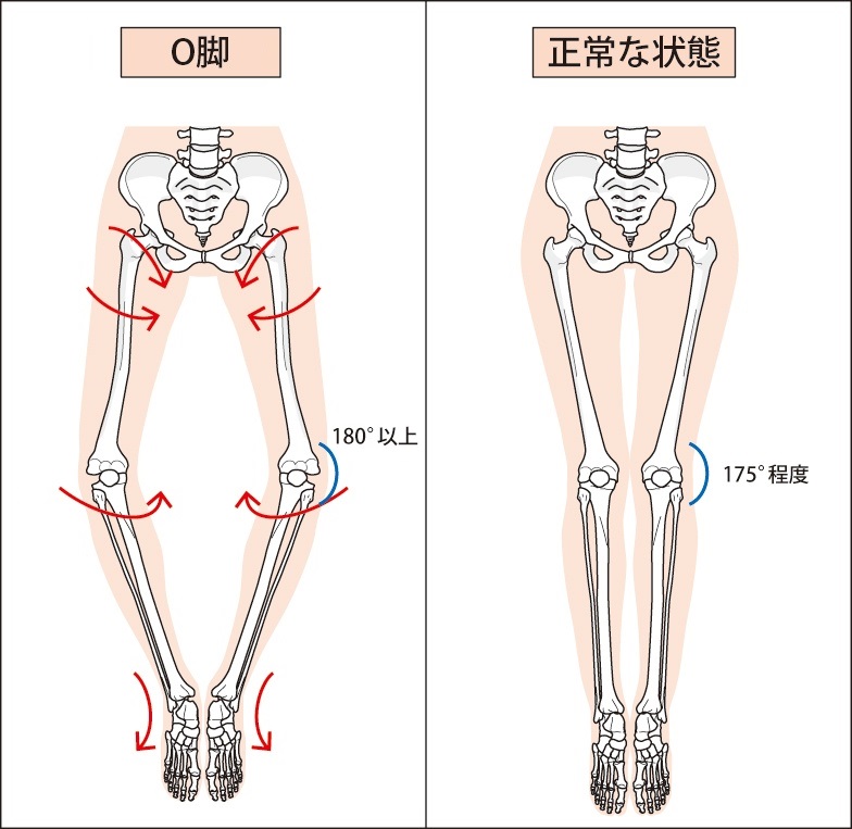 図解:正常な脚とO脚の比較