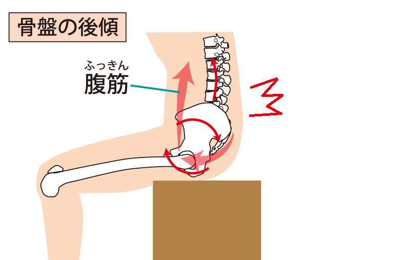 図解:骨盤の後傾