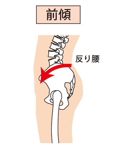 図解:骨盤の前傾