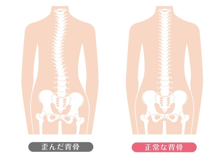 図解:正常な背骨と歪んだ背骨の比較