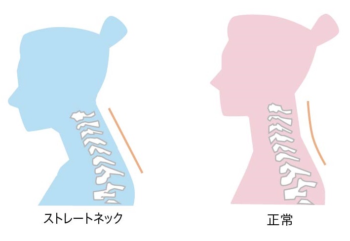 図解:ストレートネック